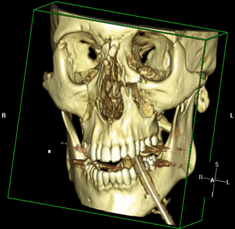 Bilde 1: 3D-rekonstruksjon av CT til en pasient med Kompleks midtansiktsfraktur etter sykkelulykke under alkoholpåvirkning.